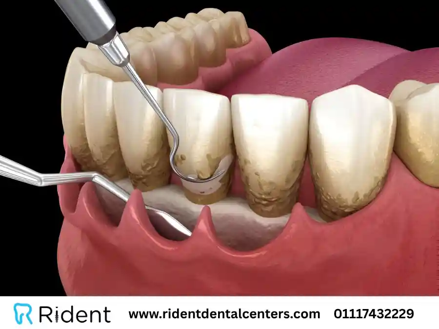 تنظيف الاسنان من الجير في 5 خطوات